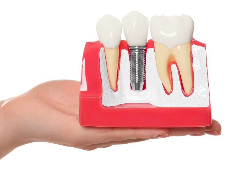 dental implants