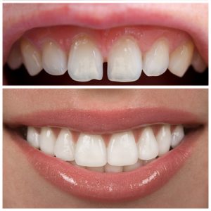 Dental veneers before and after