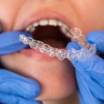 dentist fitting in a patients clear aligners
