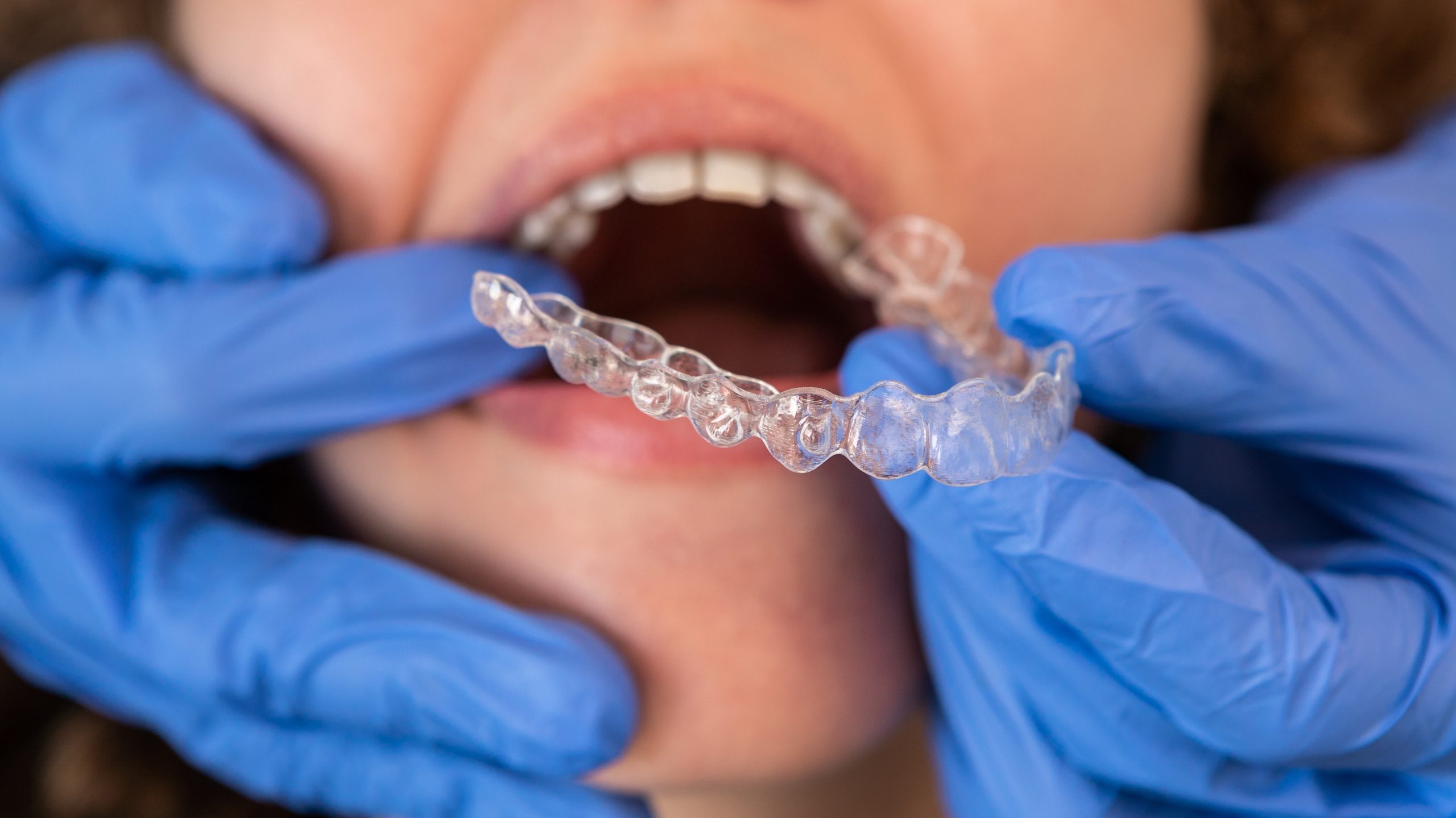 dentist fitting in a patients clear aligners