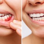 side by side closeup of gum disease progression