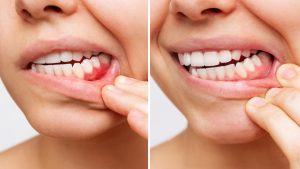 side by side closeup of gum disease progression