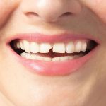 closeup of a chipped front tooth