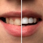 Woman smiling before and after tooth discoloration procedure