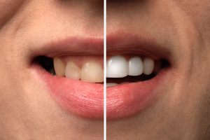 Woman smiling before and after tooth discoloration procedure